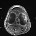 Avulsion fracture of the fibular head (Radiopaedia 74804-85808 Axial PD fat sat 20).jpg