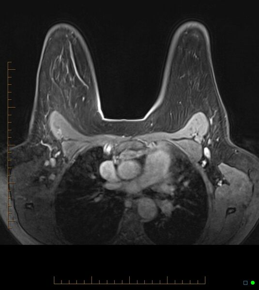 File:Axillary lymphadenopathy on breast MRI- yellow fever vaccination induced (Radiopaedia 19454-19483 Axial T1 C+ fat sat 31).jpg