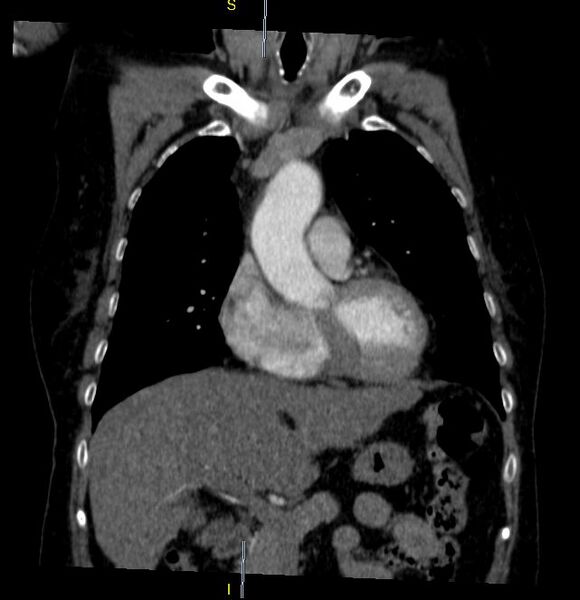File:Azygos vein aneurysm (Radiopaedia 77824-90130 C 11).JPG