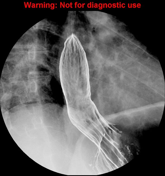 File:Barrett esophagus (Radiopaedia 44421-48075 A 9).jpg