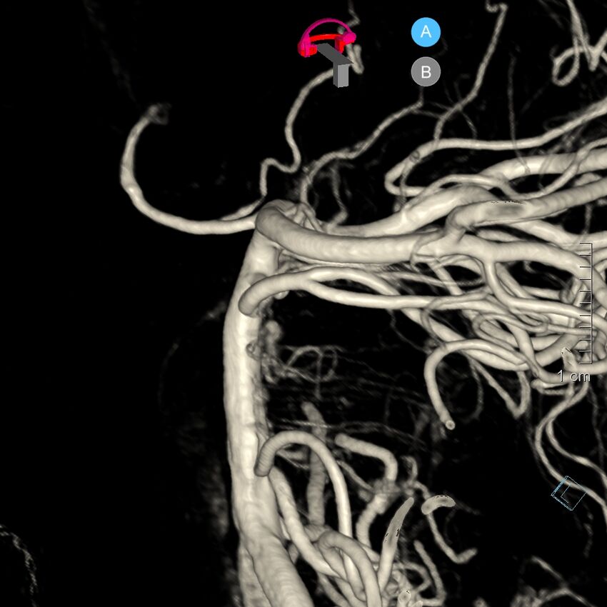 Basilar artery perforator aneurysm (Radiopaedia 82455-97734 3D view left VA 93).jpg