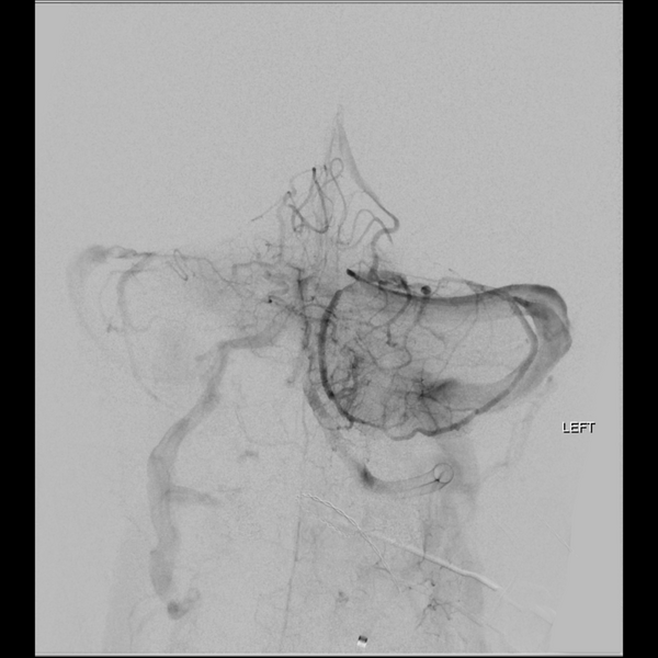 File:Basilar tip thrombus with endovascular clot retrieval (Radiopaedia 46320-50726 B 19).png