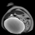 Benign seromucinous cystadenoma of the ovary (Radiopaedia 71065-81300 Coronal T2 9).jpg