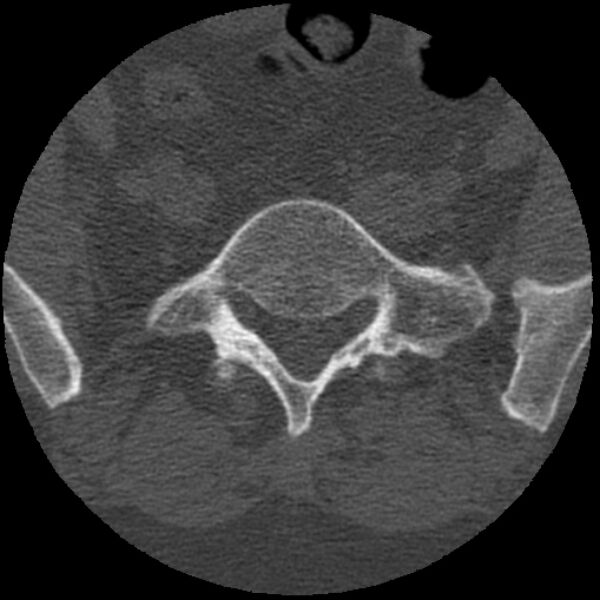 File:Bertolotti syndrome (Radiopaedia 24864-25128 Axial bone window 15).jpg