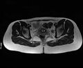 Bicornuate bicollis uterus (Radiopaedia 61626-69616 Axial T2 25).jpg