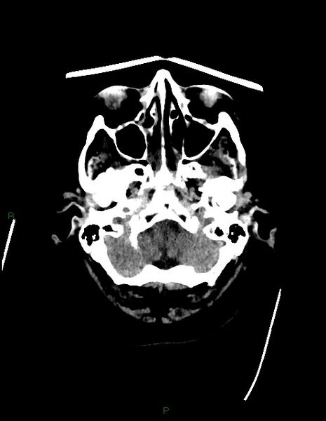 File:Bilateral acute middle cerebral artery territory infarcts (Radiopaedia 77319-89401 Axial non-contrast 10).jpg