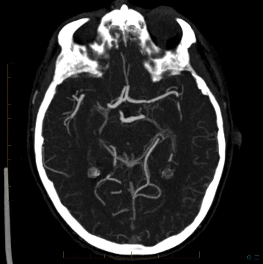 Bilateral chronic common carotid occlusion (Radiopaedia 50849-56362 D 17).jpg