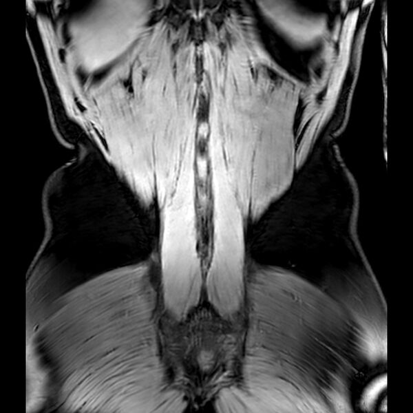 File:Bilateral conjoined nerve roots at different levels (Radiopaedia 73312-84063 Coronal WE 54).jpg