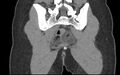 Bilateral mature cystic ovarian teratoma (Radiopaedia 88821-105592 Coronal non-contrast 35).jpg