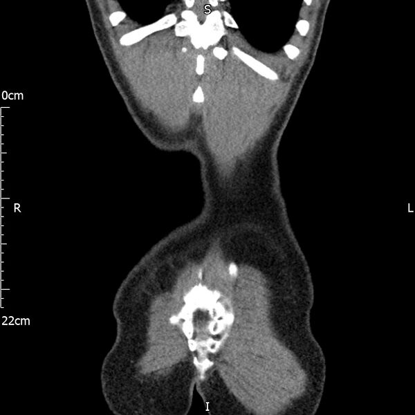 File:Bilateral medullary nephrocalcinosis with ureteric calculi (Radiopaedia 71269-81569 Coronal non-contrast 70).jpg