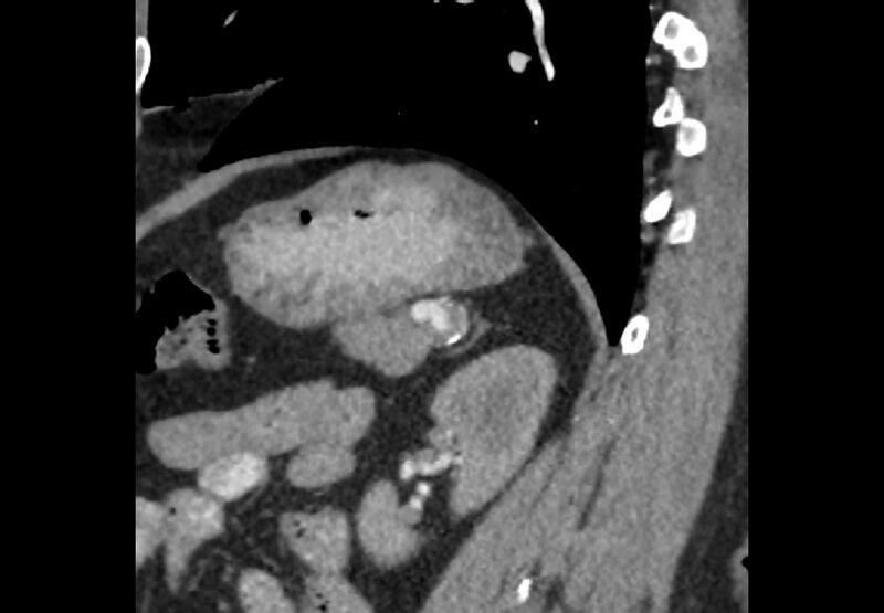 File:Bilateral urolithiasis with incidentally detected splenic artery aneurysm and left inferior vena cava (Radiopaedia 44467-48127 Ob. Sag. C+ Art. 21).jpg