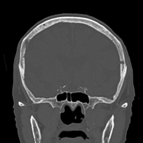 File:Biparietal osteodystrophy (Radiopaedia 46109-50463 Coronal bone window 45).jpg