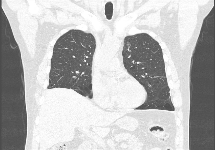 Birt-Hogg-Dubé syndrome (Radiopaedia 52578-58491 Coronal lung window 20).jpg