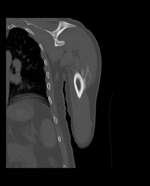 File:Bizarre parosteal osteochondromatous proliferation (Radiopaedia 84221-99501 Coronal bone window 16).jpg