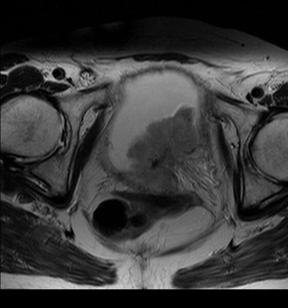 File:Bladder tumor detected on trauma CT (Radiopaedia 51809-57639 Axial T2 10).jpg
