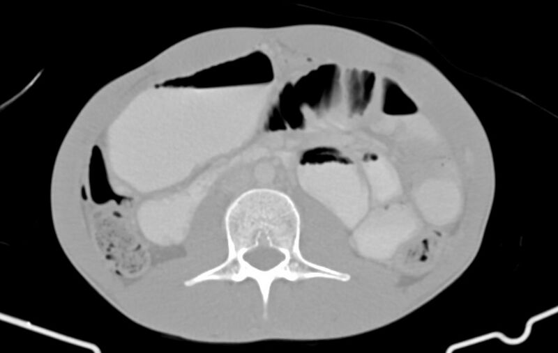 File:Blunt injury to the small bowel (Radiopaedia 74953-85987 Axial Wide 41).jpg