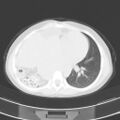 Bochdalek diaphragmatic hernia (Radiopaedia 38866-41059 Axial lung window 15).jpg
