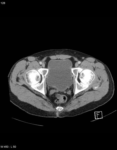 File:Boerhaave syndrome with tension pneumothorax (Radiopaedia 56794-63603 A 64).jpg
