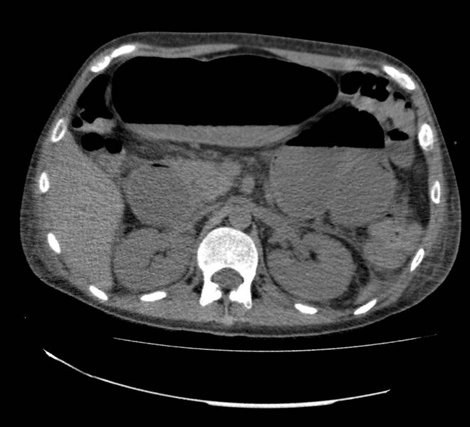 File:Bowel lymphoma complicated by bleeding after therapy (Radiopaedia 55601-62110 Axial non-contrast 28).jpg