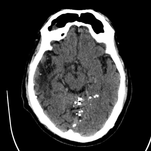 File:Brain Pantopaque remnants (Radiopaedia 78403-91048 Axial non-contrast 43).jpg