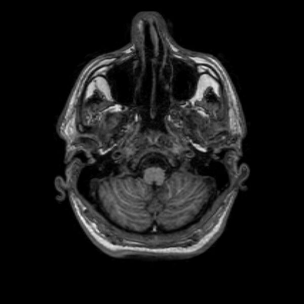 File:Brain abscess complicated by intraventricular rupture and ventriculitis (Radiopaedia 82434-96577 Axial T1 6).jpg