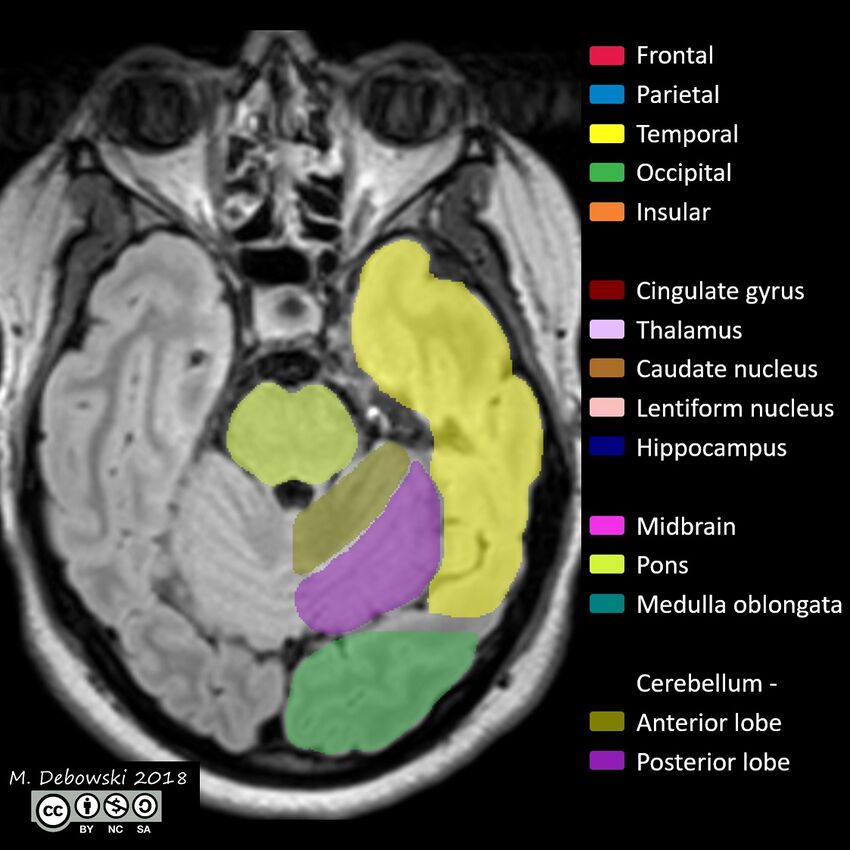 Brain lobes - annotated MRI (Radiopaedia 61691-69700 Axial 55).JPG