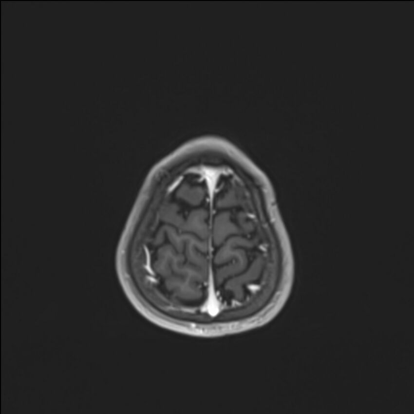Brainstem glioma (Radiopaedia 70548-80674 Axial T1 C+ 141).jpg