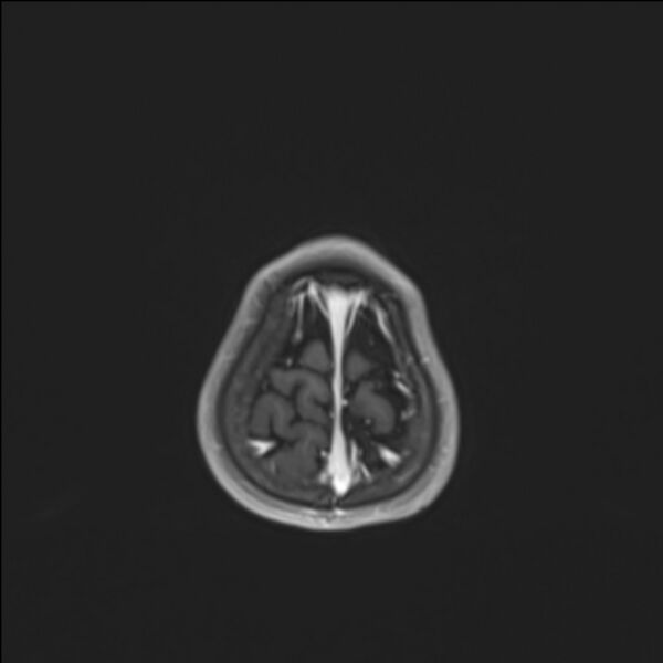 File:Brainstem glioma (Radiopaedia 70548-80674 Axial T1 C+ 144).jpg