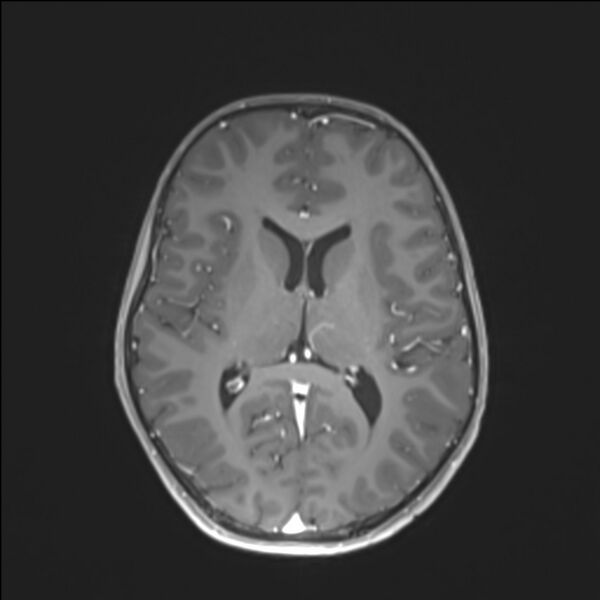 File:Brainstem glioma (Radiopaedia 70548-80674 Axial T1 C+ 90).jpg