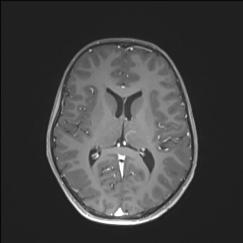 Brainstem glioma (Radiopaedia 70548-80674 Axial T1 C+ 90).jpg