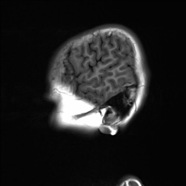 File:Brainstem glioma (Radiopaedia 70548-80674 Sagittal T1 23).jpg