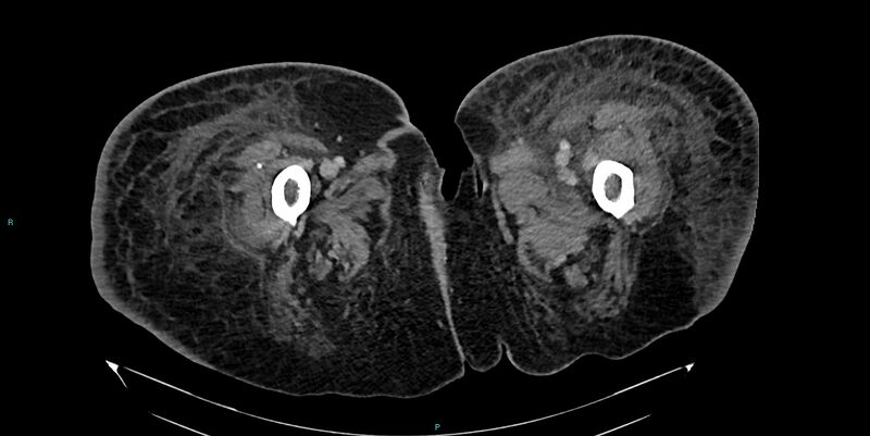 File:Breast cancer pelvic bony metastases (Radiopaedia 84470-99824 Axial bone window 85).jpg