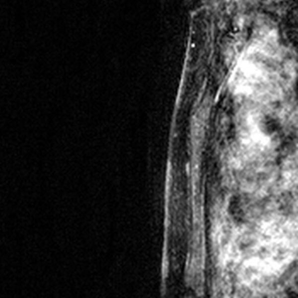 File:Breast implants - MRI (Radiopaedia 26864-27035 Sagittal T2 65).jpg