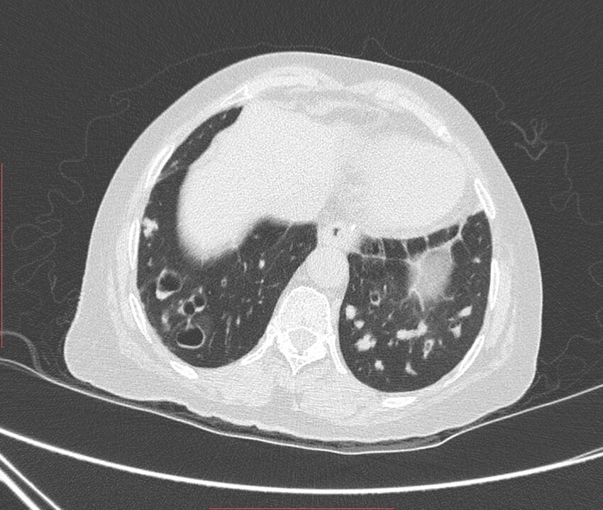 Bronchiectasis (Radiopaedia 72693-83293 Axial lung window 112).jpg