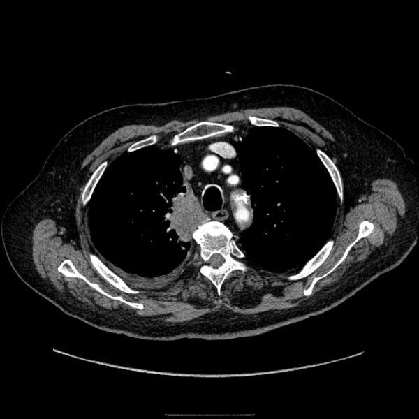 File:Bronchogenic adenocarcinoma and pulmonary embolism (Radiopaedia 9097-9806 D 19).jpg
