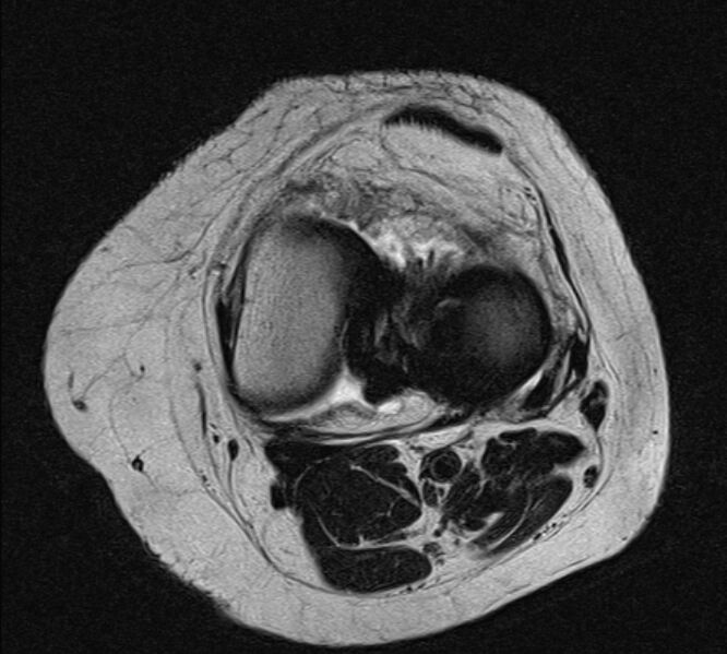 File:Bucket handle tear - medial meniscus (Radiopaedia 79028-91942 Axial T2 11).jpg