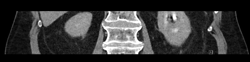 File:Buried bumper syndrome - gastrostomy tube (Radiopaedia 63843-72575 Coronal 48).jpg