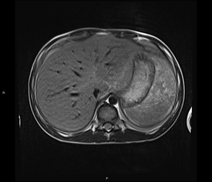 File:Burkitt lymphoma (bowel) (Radiopaedia 68839-78557 Axial T2 11).jpg