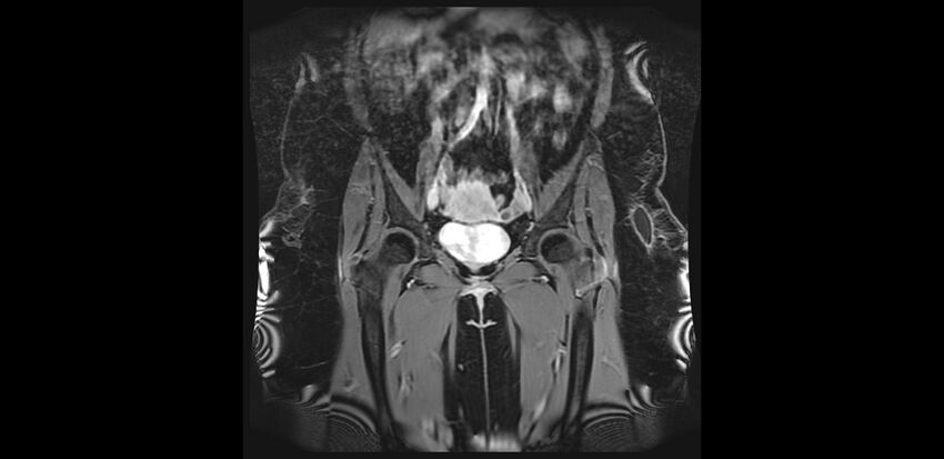 Buttock filler complications (Radiopaedia 63497-72115 Coronal T1 C+ 11).jpg