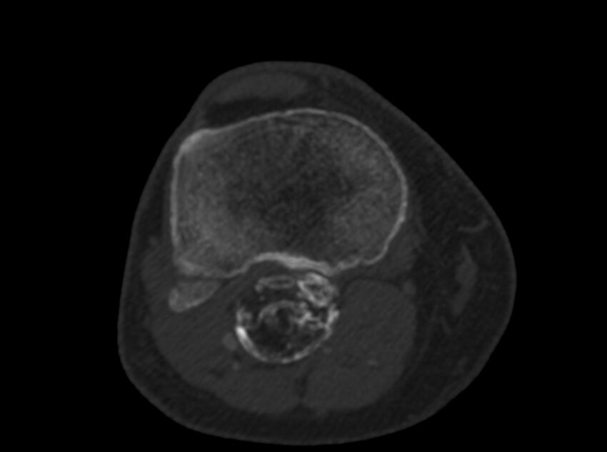 Calcified hematoma - popliteal fossa (Radiopaedia 63938-72763 C 52).jpg