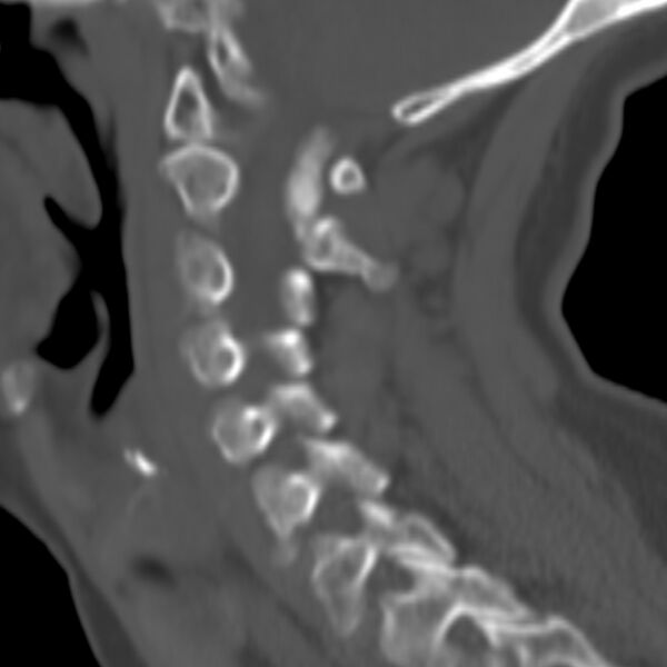 File:Calcified meningioma - cervical canal (Radiopaedia 70136-80171 Sagittal bone window 24).jpg