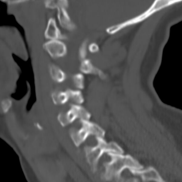 File:Calcified meningioma - cervical canal (Radiopaedia 70136-80171 Sagittal bone window 25).jpg
