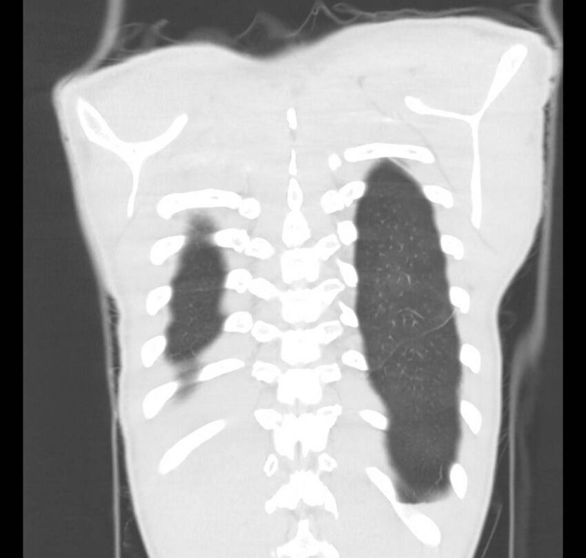 Cannabis-induced diffuse alveolar hemorrhage (Radiopaedia 89834-106946 Coronal lung window 8).jpg