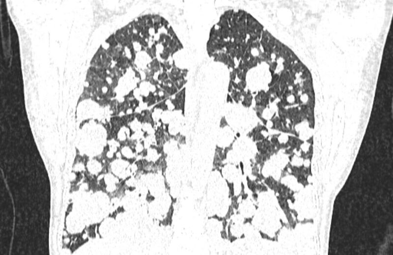 File:Cannonball metastases from breast cancer (Radiopaedia 91024-108569 Coronal lung window 96).jpg