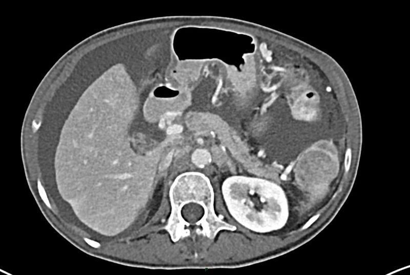 File:Carcinoid mesenteric tumor complicated by chylous ascites (Radiopaedia 76312-87953 A 22).jpg