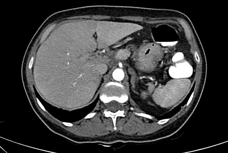 File:Carcinoid mesenteric tumor complicated by chylous ascites (Radiopaedia 76312-88926 A 17).jpg