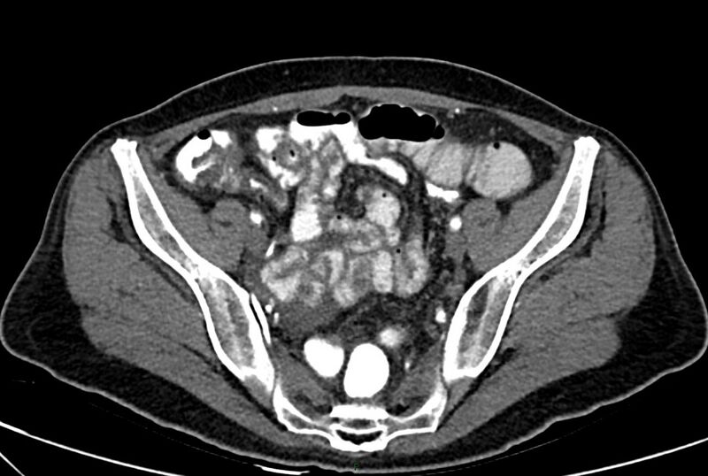 File:Carcinoid mesenteric tumor complicated by chylous ascites (Radiopaedia 76312-88926 A 59).jpg