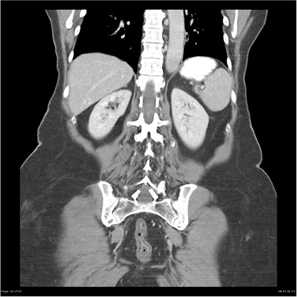 File:Carcinoid tumor of the ileum with metastasis to orbit (Radiopaedia 28165-28425 B 26).jpg