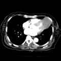 Cardiac fibroma (Radiopaedia 38974-41149 A 6).jpg