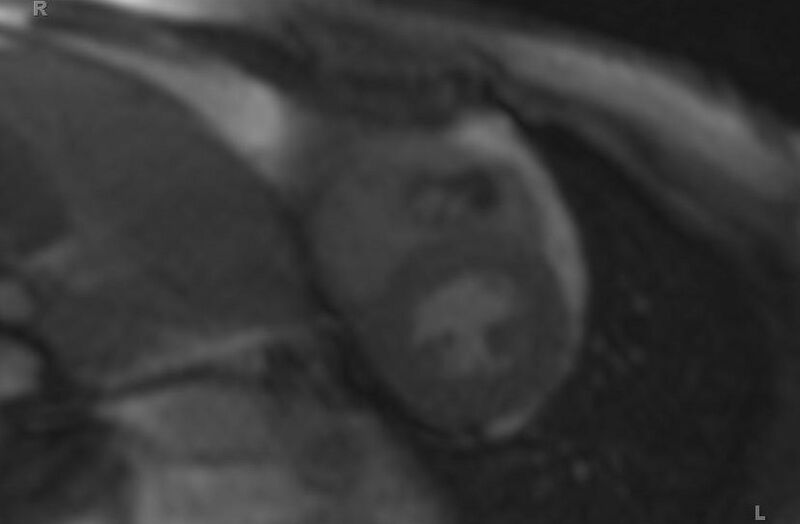 File:Cardiac hemangioma (Radiopaedia 31709-32631 Short axis 65).jpg